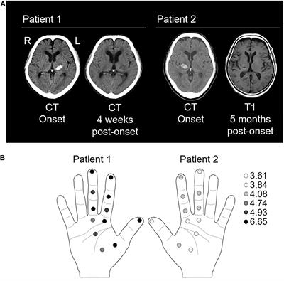 Interaction of the Left–Right Somatosensory Pathways in Patients With Thalamic Hemorrhage: A Case Report